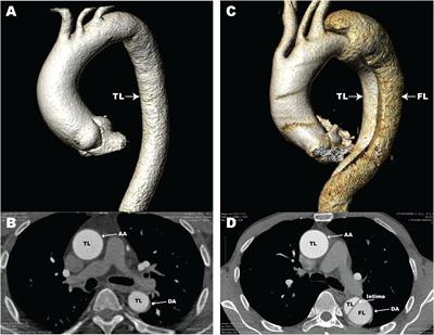 The Role of Macrophages in Aortic Dissection